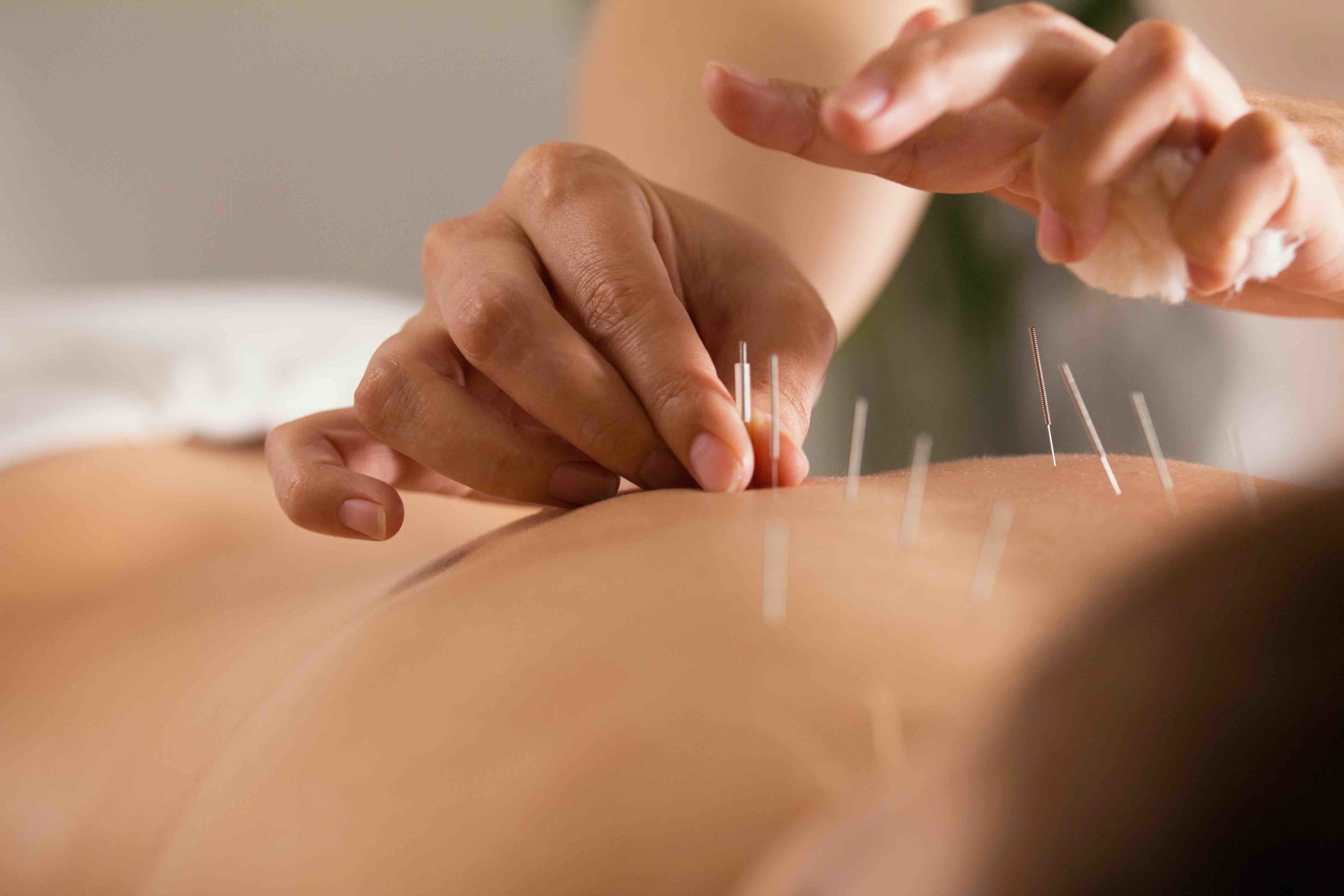 Acupuncture For Anxiety and Stress
